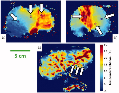 Figure 4. Selected ROI locations. MRTI data are shown from the three experiments with homogeneous baseline temperatures. Each image is a coronal temperature map of the kidney after injection, at a late time point and has three colored circles (indicated by white arrows) denoting the locations of three 2 × 2 voxel ROIs. The ROI temperature histories are plotted in Figure 7, and ROI points are color-matched to the data points of Figure 7. The surrounding reference vials are cropped. MRTI: magnetic resonance temperature imaging; ROI: region-of-interest.