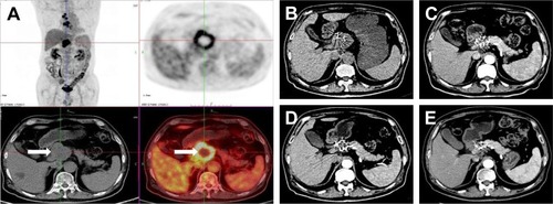 Figure 2 Images from a 63-year-old male patient diagnosed with moderately differentiated pancreatic adenocarcinoma. (A) Preoperative PET imaging; the white arrows indicate the tumor. (B–E) 1-, 3-, 6-, and 12-month CT scans, respectively, of this patient post-procedure. The lesion apparently shrunk, and the enhanced CT showed there was no activity.