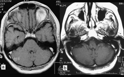 Figure 4.  Axial T1W contrast-enhanced image. Patient 4. a) Magnetic resonance imaging scan of multiple ethereal metastases without adenomatous zones around the metastatic lesions. b) Partial remission 3 months after whole-brain radiotherapy.