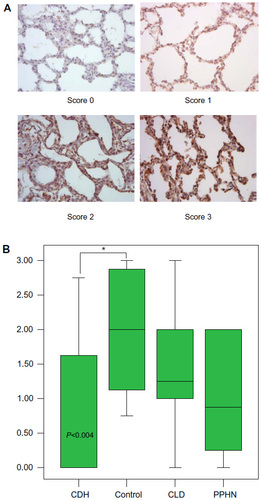 Figure 6 The BDNF representative slide staining (×400) score (0–3) (A) and the corresponding intensity staining scores (B) at the parenchymal level. The control group had score R 0.75–3.00, IQR 1.20–2.90, M 2.00. Relative to control, the CDH group had significantly lower scores R 0.00–2.75, IQR 0.00–1.60, M 0.00; P<0.004, CI 0.30–2.00. The CLD and PPHN groups had a wide range of staining intensity scores that were not significantly decreased versus control. *Shows statistical significance as indicated.