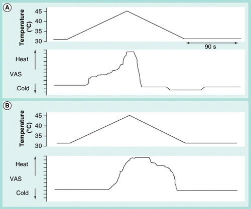 Figure 4. Dynamic psychophysical testing.Subjects are requested to reproduce their sensations when a slow rise in temperature is applied to hands or feet. The upper graph is the temperature profile and the bottom graph the subjective reproduction of the sensations. Typically, patients with polyneuropathy show a delay in perception of warm and pain, remain marking pain for longer time than healthy subjects and do not mark any decrease in temperature below neutral (the temperature at onset), in the descent phase after the stimulus. (A) Healthy subject and (B) patient with mild-to-moderate diabetic polyneuropathy.VAS: Visual analogue scale.