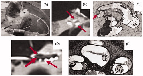 Figure 33. The back end of the catheter merged with a Luer lock system for the glass Hamilton syringe to be connected (A). The iodine solution was injected using the catheter, which stayed in the ST even in the second turn of the cochlea, as seen in CT imaging (B). Histological analysis of the cochlea with the catheter inside showed the presence of catheter wholly positioned in the ST with no deviation to SV (C). CI electrode array insertion, following the catheter removal, stayed completely inside the ST, as seen in the CT imaging (D) and the corresponding histological analysis visually confirmed the ST position (E) [Citation35]. Reproduced by permission of Wolters Kluwer Health, Inc.