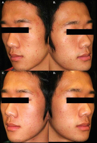 Figure 1. A representative case with excellent outcomes (A,B: before PDT; C: chlorophyll-treated side; D: light only side, after PDT).