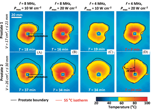 Figure 4. Effects of acoustic frequency and power on transurethral prostate treatment outcomes. Modeling of the maximum temperature distribution calculated for a central plane in 2 prostate glands treated under different conditions. (a) f = 8 MHz, Pmax = 10 W cm−2, (b) f = 8 MHz, Pmax = 20 W cm−2, (c) f = 4 MHz, Pmax = 10 W cm−2, (d) f = 4 MHz, Pmax = 20 W cm−2.