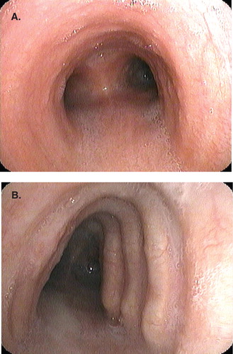 Figure 1. Image on bronchoscopy of normal carina in the trachea (A) and complication of chronic obstructive pulmonary disease, saber sheath trachea (B).