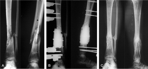 Figure 2. Case 4.Infected nonunion of the distal third of the tibia and nonunion of the fibula.The external fixator that was used initially had been removed before the patient was referred to us (A).After completion of the first-stage surgery (B).Bone healing at the last follow-up, 40 months after second-stage surgery (C).