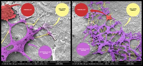 Figure 13 Scanning electron micrographs of bone defects filled with nano-hydroxyapatite/ß tricalcium phosphate showing the surface of the bone matrix. The highlighting images are suggestive of collagen fibrils (yellow), collagen fibrils associated with other types of proteins (magenta) and possibly starting the process of the extracellular matrix formed by an aggregate of glycoproteins and bundles of collagen fibers; and a fibroblast (red). (A) scale bar = 40 µm, x1000; (B) scale bar 100 µm, X 250 magnification.