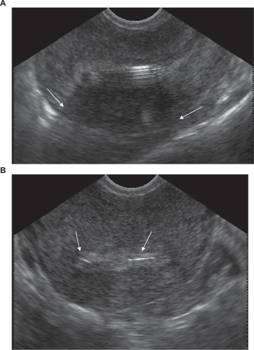 Figure 4 The levonorgestrel-releasing intrauterine system can be easily identified on transvaginal ultrasound. Note the shadowing caused by the stem of the device (arrows) in the anterior-posterior plane (panel A), and the T bar seen in the transverse orientation (panel B).