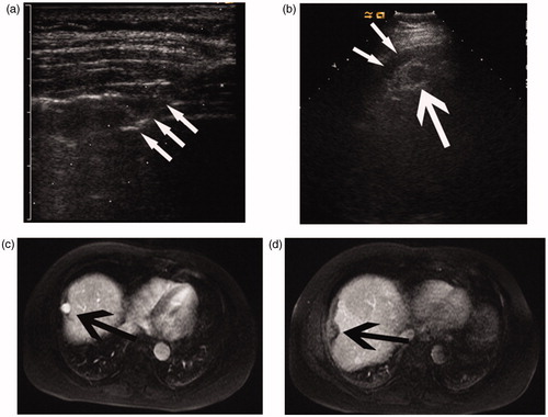Figure 3. Images of a 48-year-old man with a 2.2-cm HCC treated by percutaneous MWA with artificial pleural effusion. (a) Sonogram shows the puncture of the pleural cavity. Note the 16-gauge BD Angiocath needle (arrow). (b) Sonogram shows the hypo-echoic nodule (large arrow) with the artificial pleural effusion (thin arrows). (c) Transverse preablation contrast-enhanced MR image shows the hyperintense neoplasm (arrows) located in the hepatic dome. (d) Transverse arterial phase MR image 1 month after MWA shows no enhancement in the ablation zone (arrow).