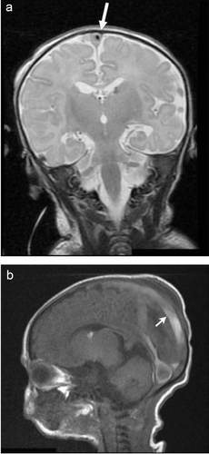 Figure 1.  (a) Coronal T2-weighted MRI showing saggital sinus thrombosis (arrow). (b) Saggital T1-weighted MRI showing saggital (arrow) and straight sinus thrombosis.