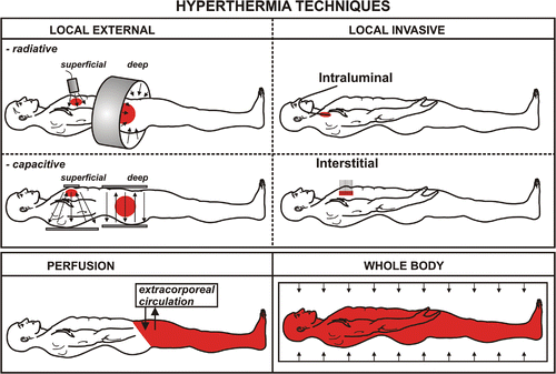Figure 1. Methods for clinical application of hyperthermia.