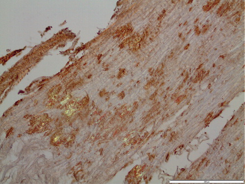Figure 1. Section of ligament with amyloid deposits immunolabeled for transthyretin and stained with Congo red. Overlapping of immunoreaction with Congo red positivity is evident. Polarized light with partially crossed polars. Bar 200 µm.