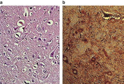 Figure 9. Neuronal damage (a) and albumin leakage (b) in the cerebral cortex of pigs treated with adrenaline only during CPR after cardiac arrest (background study). Massive neuronal damage with perineuronal edema and sponginess was evident (b). There was profound leakage of albumin in the neuropil and strong albumin-positive nerve cells as well (b). ×300.