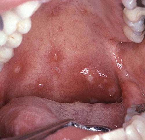 Figure 4. Aphthous stomatitis.