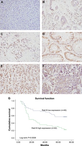 Figure 1 Expression of Rab18 in gastric cancers.