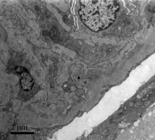 Figure 3. Electron-dense deposits in mesangium were seen by electron microscopy (arrowheads).