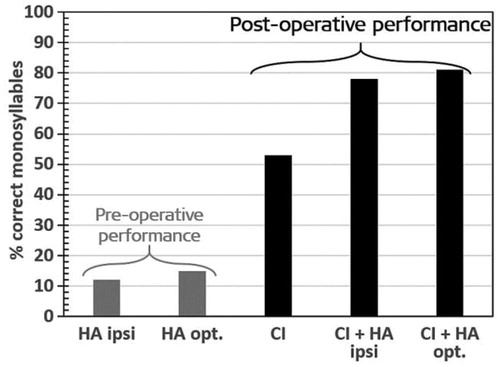 Figure 6. Preoperative Freiburg monosyllabic word scores, tested with the ipsilateral HA and in the best-aided condition at optimal loudness. Postoperative monosyllabic word score with CI alone at 70 dB presentation level, and with CI + HA in the ipsilateral ear (n = 4), as well as CI + HA in the optimal condition—either ipsi-, contra-, or bi-lateral at 70 dB. Histogram created from the data given in Kiefer et al. [Citation5].