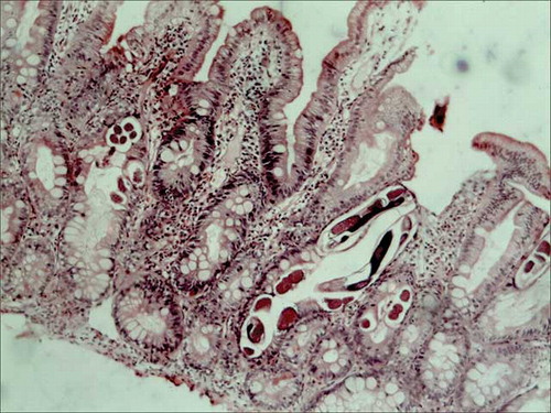 Figure 2.  Duodenal mucosal biopsy showing strongyloides larvae within glands (arrow), hematoxylin eosin stain, 200×.