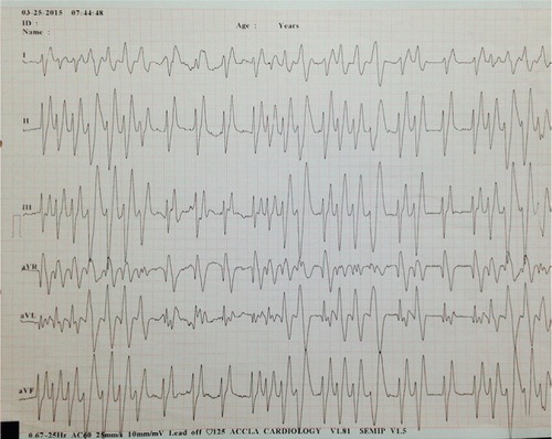 Figure 1 Presenting electrocardiogram.