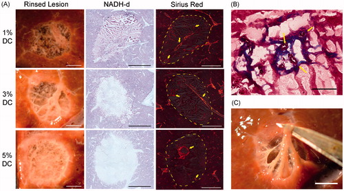 Figure 9. (A) Photos of boiling histotripsy lesions in ex vivo bovine liver in cross-section after rinsing (left). Rinsed lesions reveal remaining vasculature and connective tissue that were preserved after sonication. Histomicrographs of representative sections stained with NADH-d (centre) and picrosirius red (right). Unstained regions in the NADH-d stained sections indicate thermal damage. Orange-red birefringence in the picrosirius red stain sections indicate fibrillar collagen (yellow arrows). Large calibre vessels can be observed to be intact. Dashed yellow line indicates the border of the lesions. Scale bar represents 5 mm. (B) Masson’s trichome stained sections showing small calibre patent vessels (yellow arrows). Scale bar represents 100 μm. (C) Cross section of volumetric lesion with lysed cell debris washed out and with the remaining connective tissue manipulated. Scale bar represents 5 mm.