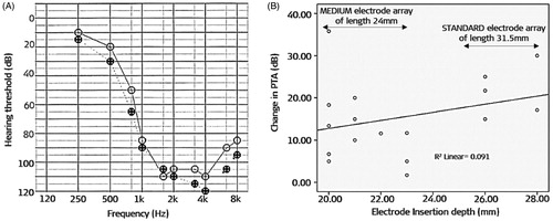 Figure 48. Example audiogram of pre-op (open-circle) and post-op (crossed circle) with the MEDIUM performed with a MED-EL STANDARD electrode array. The HP remained stable over eighteen months (A). Effect of electrode insertion depth on postoperative change in hearing (B). Using the RW approach, there was no clear relationship between implant insertion depth and post-operative PTA [Citation50]. Reproduced by permission of Journal of American Academy of Audiology.