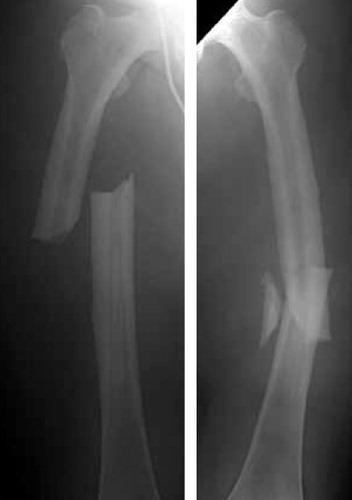 Figure 3. Fractures of the left and right femurs.