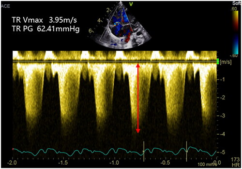 Figure 1. Tricuspid regurgitation peak velocity (Vmax TR). The estimation of systolic pulmonary artery pressure (sPAP) can be derived from the tricuspid regurgitation jet. The peak velocity of the tricuspid regurgitation jet measures 3.95 m/s, which corresponds to a maximum pressure gradient of 62.41 mmHg as per the modified Bernoulli equation.