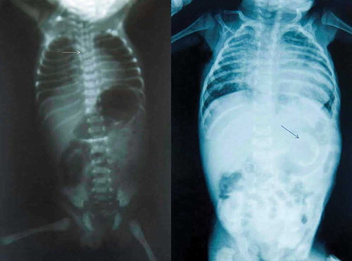 Figure 2. Anterioposterior chest and abdomen radiograph shows the vertebral deformities and colostomy.