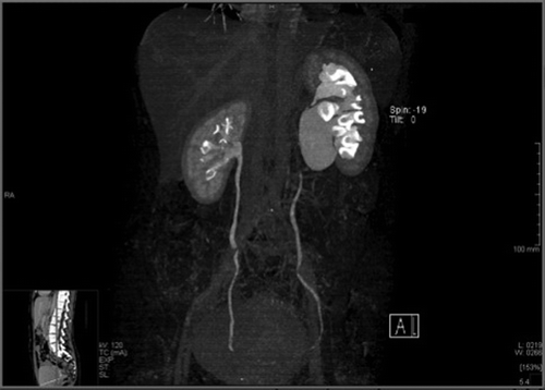 Figure 1. Computerized tomography scan revealing a hydronephrosis of the left kidney with a markedly dilated renal pelvis.