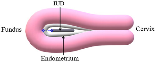 Figure 2. Illustration of the IUD-myometrium distance used in the current study (dashed line in blue).
