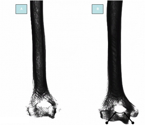 Figure 3.  Photograph of skiagram of humerus (postero-anterior view). postero-anterior view of the lower end of the humerus. A: humerus with translucent septum; B: humerus with supratrochlear foramen. The margin of the supratrochlear foramen is clearly marked by the two arrows on the inferior aspect. Note: The translucent septum is not well margined whereas the supratrochlear foramen has clear margins.