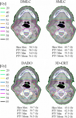 Figure 1.  Comparison of isodose distributions for a head and neck patient using DMLC, SMLC, DABO and 3D-CRT. The median doses of the PTVs were set to 56 Gy (normalized to 100%).