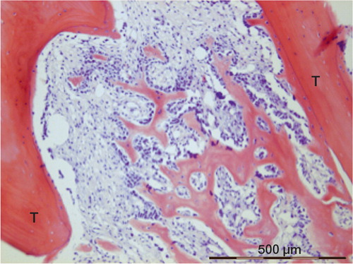 Figure 2. Formation of woven bone in the marrow cavity between 2 old trabeculae (T), in which superficial osteocytes have survived. Specimen from 16 days after injury.