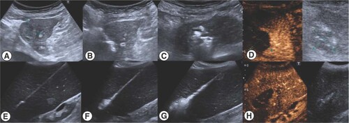 Figure 1. Progressive visibility of ongoing ablation under ultrasound with the TATO microwave system.Contrast enhanced ultrasound was performed just a few minutes after the procedure and before it was finished to certify a complete ablation in the same act (A–D) HCC in close relationship with the heart. (E–H) Spleen diffuse ablation in malignant splenomegaly.