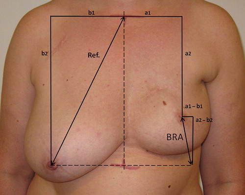 Figure 3. Example of the measurement points of BRA – the Breast Retraction Assessment. BRA = Display full size.