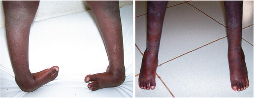 Figure 4. 8-year-old boy before treatment. After treatment.