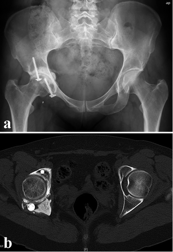 Figure 5. Case 11. a. After intralesional resection of a GCT of the ischium. Additional curettage and bone cement packing of the acetabular extension was performed. The cement was fixed with 2 screws to prevent dislocation. b. CT showing dislocation of the dorsal screw, necessitating surgical removal.