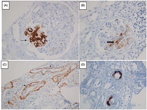 Figure 1. C4d staining in different sites of kidney biopsy specimens of patients with primary IgAN. (A) C4d staining in a segmentally sclerotic mesangial area. (B) C4d staining in another mesangial area with no sclerosis. (C) C4d staining in renal tubular epithelium. (D) Interlobular arterial C4d staining (stained with anti-C4d monoclonal antibody; magnification ×20).