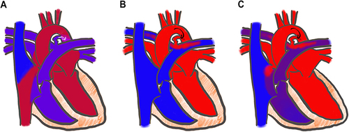 Figure 1 Illustration of the ductal shunt over time. Arrows indicate the direction of blood flow across the ductus. (A) The fetal duct is a physiologic right to left shunt allowing right ventricular output to supply systemic circulation. (B) In the transitional period after birth, the shunt becomes bidirectional or left to right before spontaneous closure. (C) In the case of a prolonged patent ductus, a pathologic left to right shunt contributes to pulmonary over circulation and dilation of the left atrium and the left ventricle.