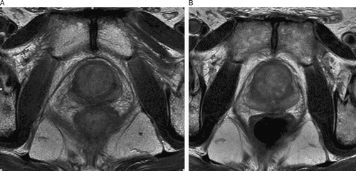 Figure 2.  (A) T2-weighted MRI before start of AD. (B) T2-weighted MRI at 9 months follow-up.