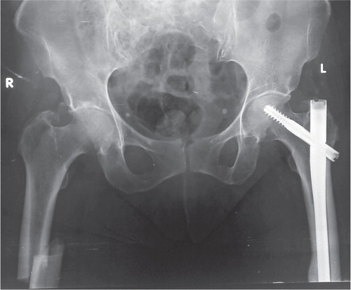 Figure 2. Both femurs at the time of the right femoral shaft fracture.