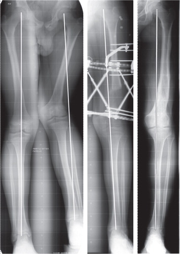 Figure 5. A patient with a biplanar deformity (shortening and valgus) after physeal injury (fixator group: pair 10), which was corrected with the Taylor Spatial Frame.