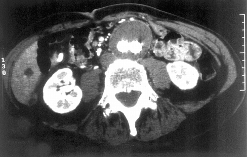 Figure 2 CT Scan of the aneurysm of the abdominal aorta fitted with the AneuRx endovascular prosthesis. The limbs of the device within the aneurysmal sac are well delineated and the content of the sac appears solidified.