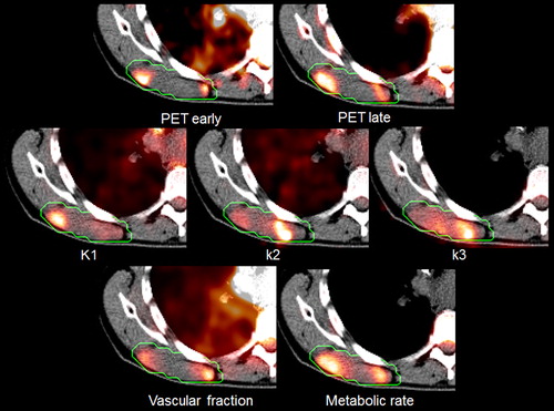 Figure 4. Parameter maps for patient 11 derived from the pharmacokinetic analysis. In addition, two static snapshot PET images obtained 2 and 45 min p.i. are shown. The tumor border is marked with a green line.