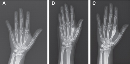 Figure 1. (a) Preoperative plain film showing an expansile osteolytic lesion in the left second metacarpal bone. (b) Immediate postoperative plain film revealing a bone defect with a hyperdense mass. (c) Three-year postoperative plain film showing consolidation and remodeling of the bone lesion without fracture.