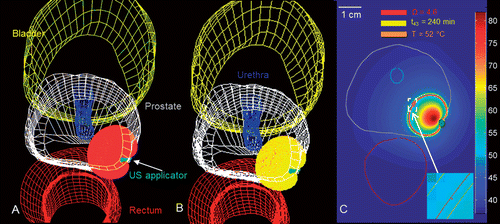 Figure 8. Patient-specific treatment simulation and plan for targeting prostate cancer in the posterior gland using a directional (90°) interstitial ultrasound applicator implanted in the peripheral gland and directed toward the urethra. (A) Thermal damage (Ω ≥ 4.6) and temperature (T ≥ 52°C) isosurfaces indicating coagulative necrosis. (B) Thermal dose (t43 ≥ 240 min) and temperature (T ≥ 52°C) isosurfaces indicating coagulative necrosis. (C) Temperature map in axial slice through the centre of the applicator with critical temperature, thermal dose and thermal damage contours overlaid.