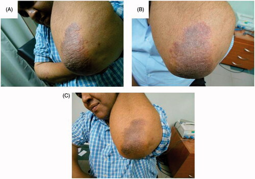 Figure 1. Assessment of the left elbow psoriatic lesion treated with MTX microemulsion formulation only along the treatment course for patient 1: (A) before treatment, (B) after 3 weeks of treatment and (C) after 8 weeks of treatment.