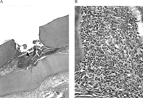 Figure 1 Histologic slide after pulp capping with Ca(OH)2 in teeth of rat after first day. (A) magnified l0×: (a) Superficial coagulation necrosis). (B) magnified 40×: After seventh day, chronic inflammatory infiltrate is seen (H&E).