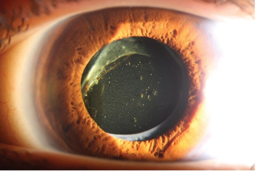 Figure 3. Patient with homocystinuria, 30 years of age, who underwent ocular surgery at 25 years of age because of ectopia lentis, where the crystalline luxated lens was removed and replaced with an intraocular lens (IOL). Several surgical re-operations were needed as the IOL also luxated. Diagnosis of HCU was established three years after the first surgery.