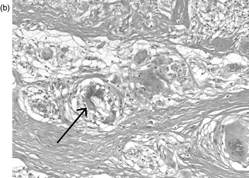 Fig. 2b.  H&E, 200x magnification. A multinucleate giant cell contains polarisable foreign material (arrow) amongst the non-necrotising granulomata.